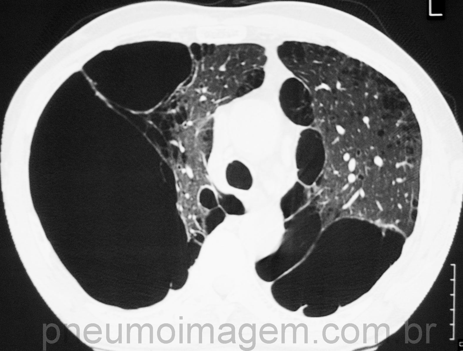 Tomografia de t�rax com enfisema pulmonar.